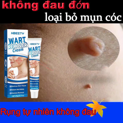 Kem Mụn Cóc, Mụn Thịt, Mụn Cơm Hiệu Quả – Chiết Xuất Thảo Dược An Toàn 20g, ĐÈN TRANG TRÍ , ĐỒNG HỒ TREO TƯỜNG