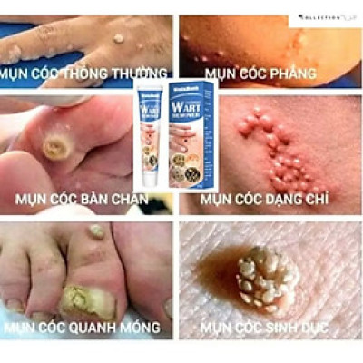 HỘP KEM BÔI TRỊ HẾT MỤN CÓC NÚT RUỒI DA ĐEN SẠM THUẬN TIỆN CHO MỌI NGƯỜI