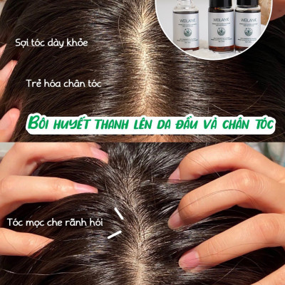 Serum Huyết Thanh Mọc Tóc Weilaiya Hỗ Trợ Giảm Rụng, Kích Mọc Tóc Nhanh - Set 8 Lọ x 5ml