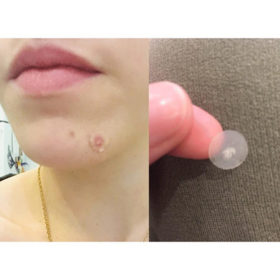 Miếng dán mụn Mayan Care Ultra Thin Spot