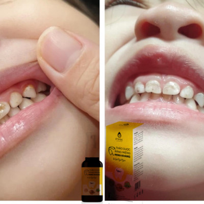 THẢO DƯỢC RĂNG MIỆNG MINH KHANG