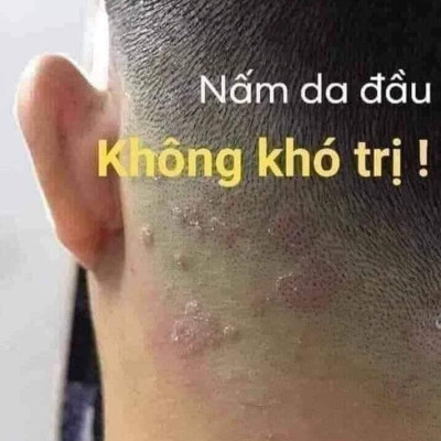 Kem Bôi Nứt Nẻ Á Sừng Tay Chân Ngoài Da - Hàng Nhập Khẩu