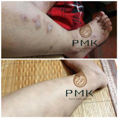 Tinh Chất Serum Mờ Thâm Minh Khang - Hết mọi loại thâm, an toàn, lành tính sử dụng mọi lứa tuổi